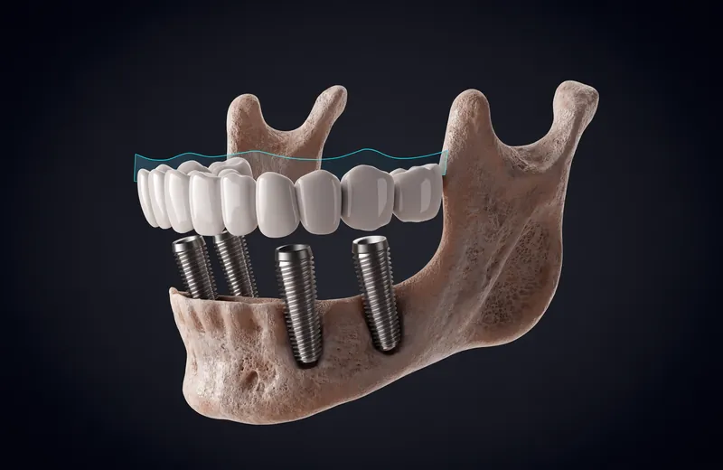 Render of a full fixed bridge supported by four angled titanium implants