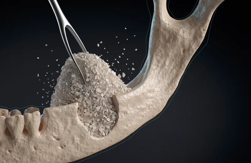 Render of granular bone graft material being placed into a jawbone defect