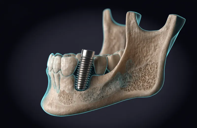 Anatomical render of a single titanium implant anchored in the jawbone