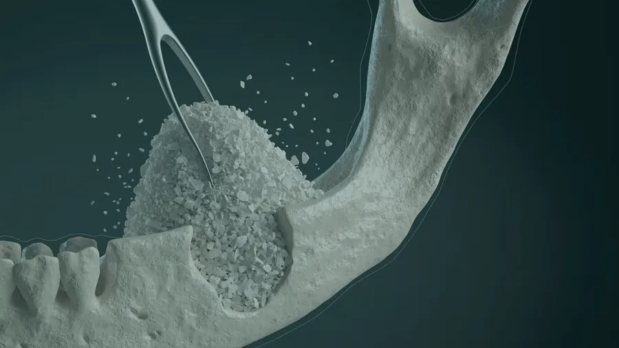 Do you need a bone graft or a sinus lift?