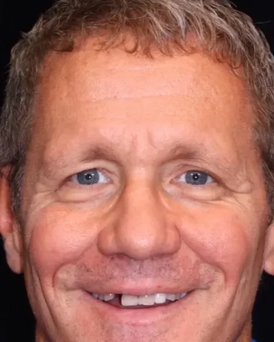 Before and after full-arch implant treatment with zirconium crowns, male patient aged 55