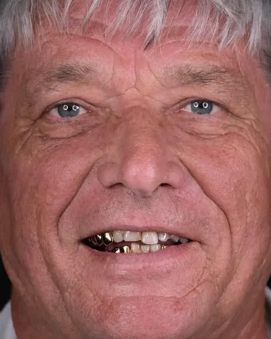 Before and after full mouth restoration, male patient