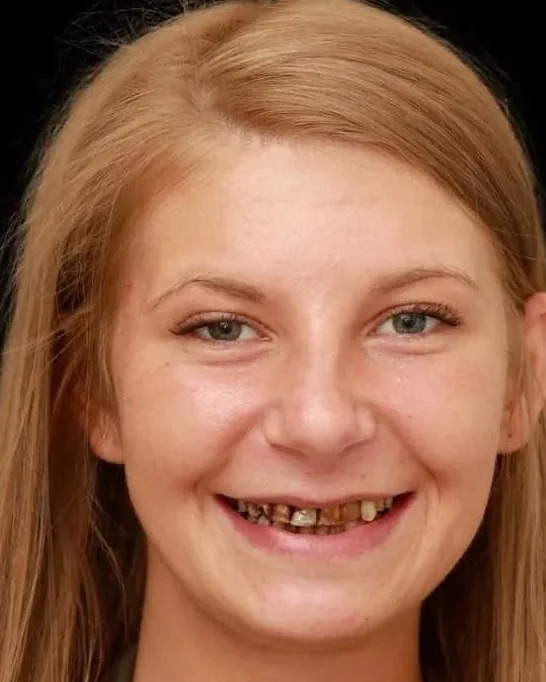Before and after smile correction, young female patient