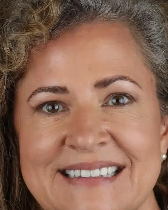 Before and after digital smile design with ceramic crowns, female patient